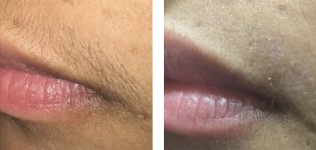 hair removal